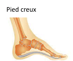 Pied creux